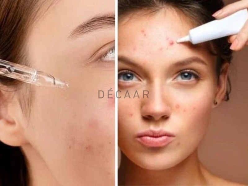 serum trị mụn cho da dầu